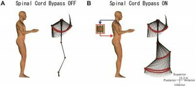 midollo spinale bypass