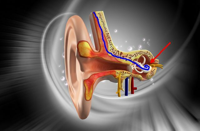 cocleare-implant2